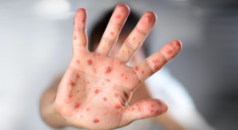 Measles Exposure in Montreal: Public Health Concerns for Parc-Extension Residents